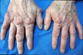 Complément alimentaire Arthrose Hondro Sol