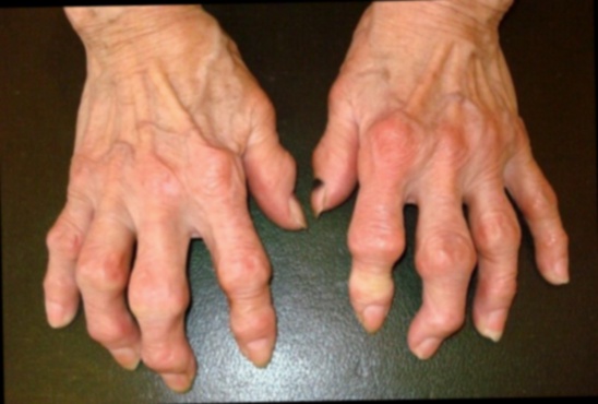 Hondro Sol Anti-inflammatoire