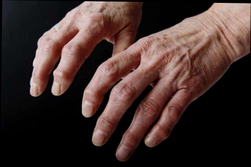 Hondro Sol remède grand mère articulations